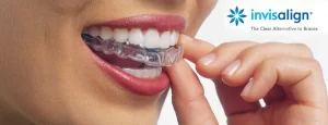 Invisalign clear aligners