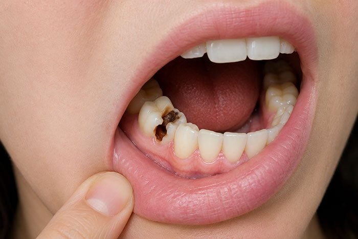 Close-up of a visible dark cavity on a lower molar
