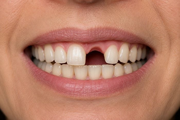 Smile with a gap from a missing upper front tooth