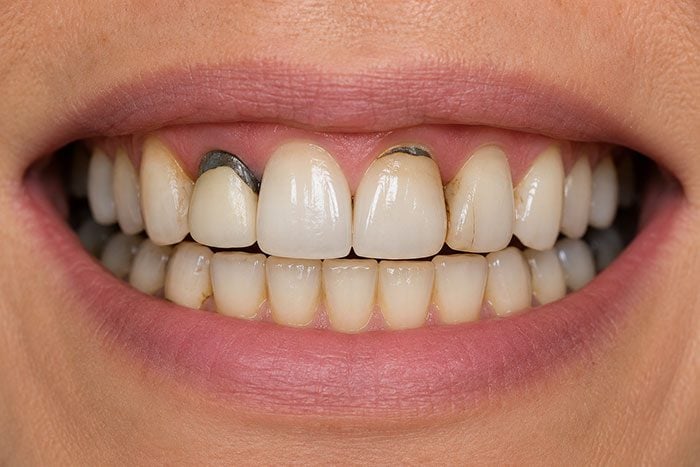 Teeth with dark metal fillings visible at the gumline