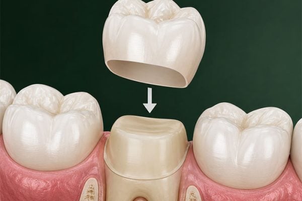 Illustration of a tooth-colored dental crown placed over a prepared tooth
