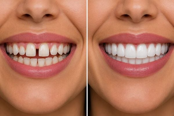 Before and after gap between front teeth closed with composite bonding